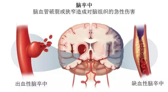 【擴(kuò)散】針眼大的口子，就能檢查腦血管??？(圖2)