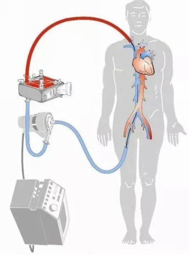 首例！救命的硬核武器—ECMO技術(shù)在西南醫(yī)大附院成功開(kāi)展(圖1)