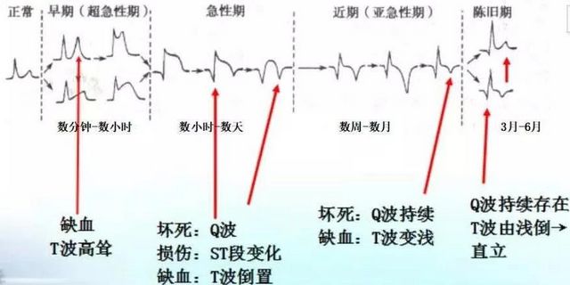 你的心臟在求救！急性心梗的這些預(yù)警信號(hào)， 你知道嗎？(圖9)